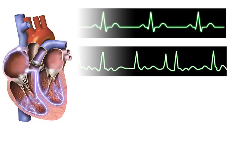 Atrial Fibrillation ECG